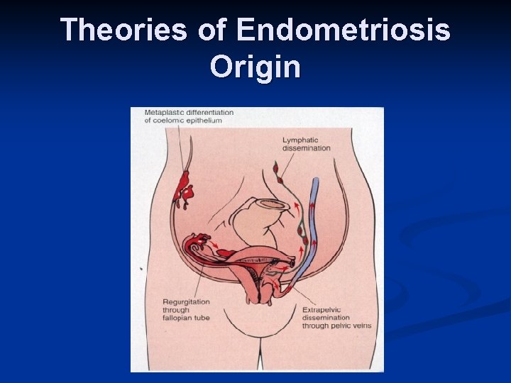 Theories of Endometriosis Origin 