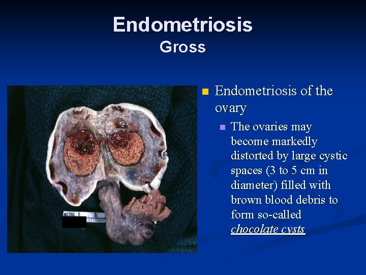 Endometriosis Gross n Endometriosis of the ovary n The ovaries may become markedly distorted