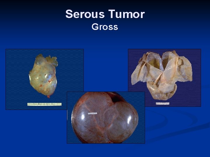 Serous Tumor Gross 