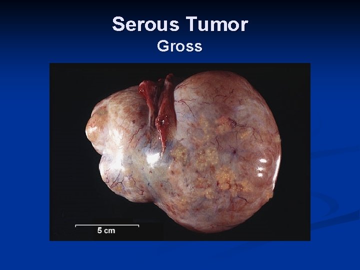 Serous Tumor Gross 