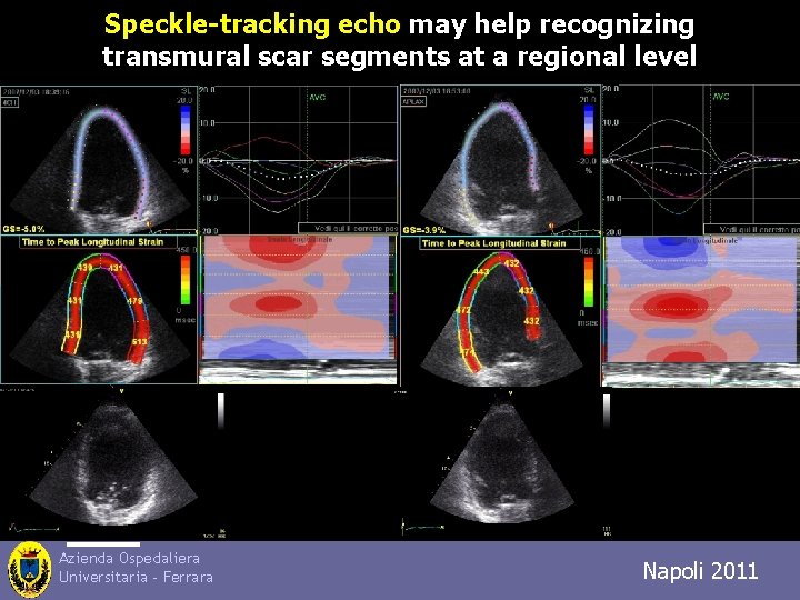 Speckle-tracking echo may help recognizing transmural scar segments at a regional level Azienda Ospedaliera