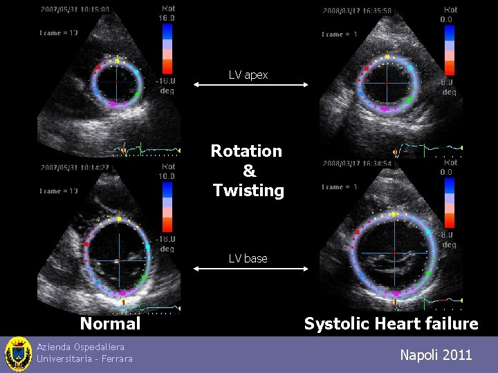 LV apex Rotation & Twisting LV base Normal Azienda Ospedaliera Universitaria - Ferrara Systolic