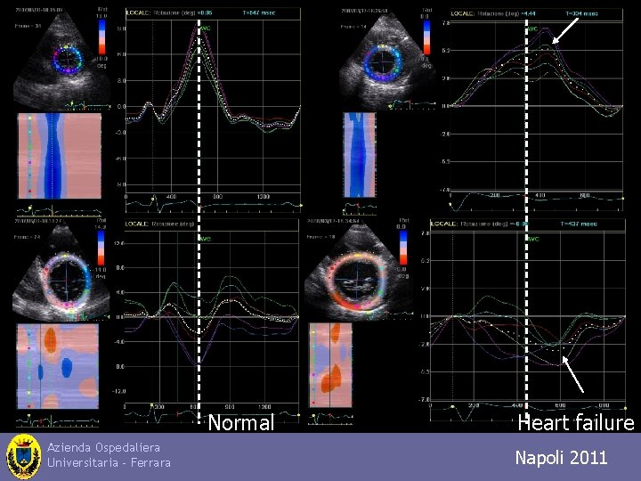 Normal Azienda Ospedaliera Universitaria - Ferrara Heart failure Napoli 2011 Trieste 2010 