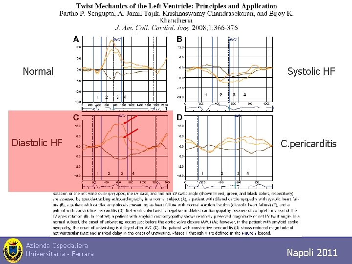 n Normal Systolic HF Diastolic HF C. pericarditis Azienda Ospedaliera Universitaria - Ferrara Napoli