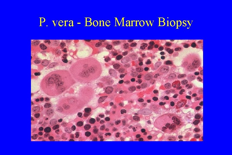 P. vera - Bone Marrow Biopsy 