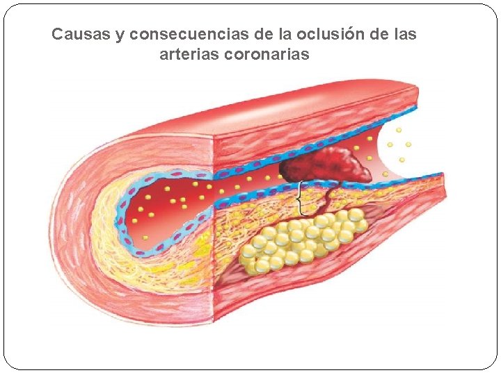 Causas y consecuencias de la oclusión de las arterias coronarias 