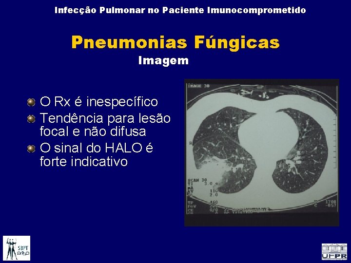 Infecção Pulmonar no Paciente Imunocomprometido Pneumonias Fúngicas Imagem O Rx é inespecífico Tendência para