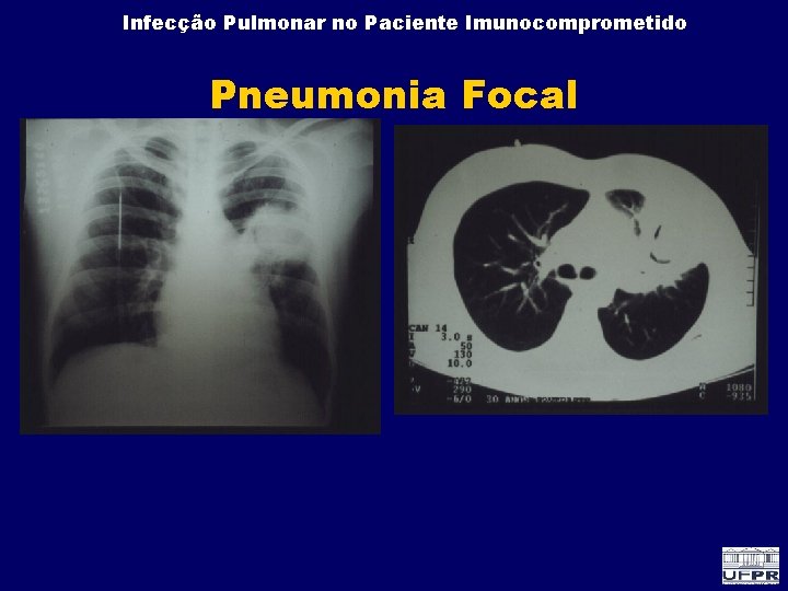 Infecção Pulmonar no Paciente Imunocomprometido Pneumonia Focal 