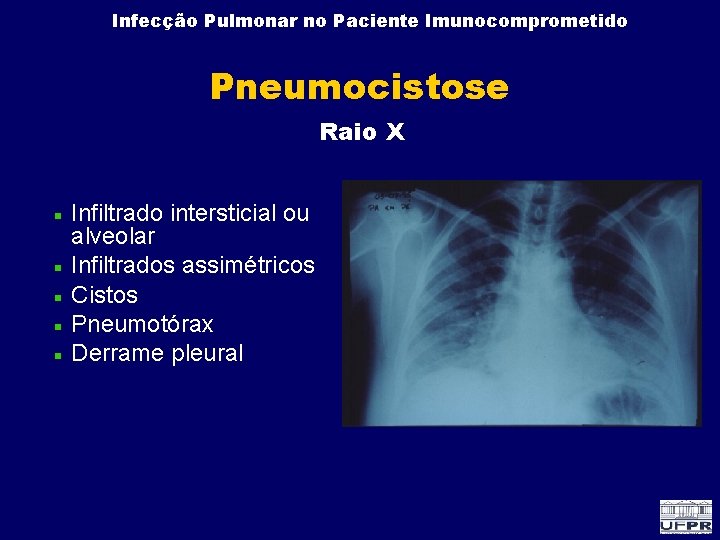 Infecção Pulmonar no Paciente Imunocomprometido Pneumocistose Raio X Infiltrado intersticial ou alveolar Infiltrados assimétricos