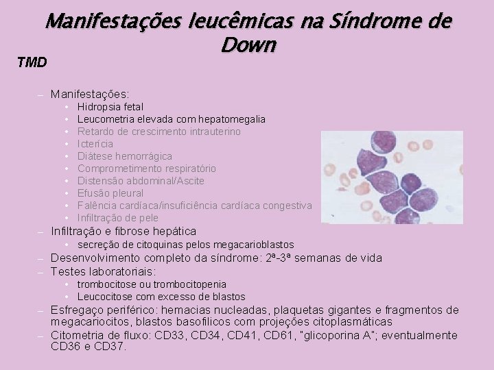 Manifestações leucêmicas na Síndrome de Down TMD – Manifestações: • • • – Hidropsia