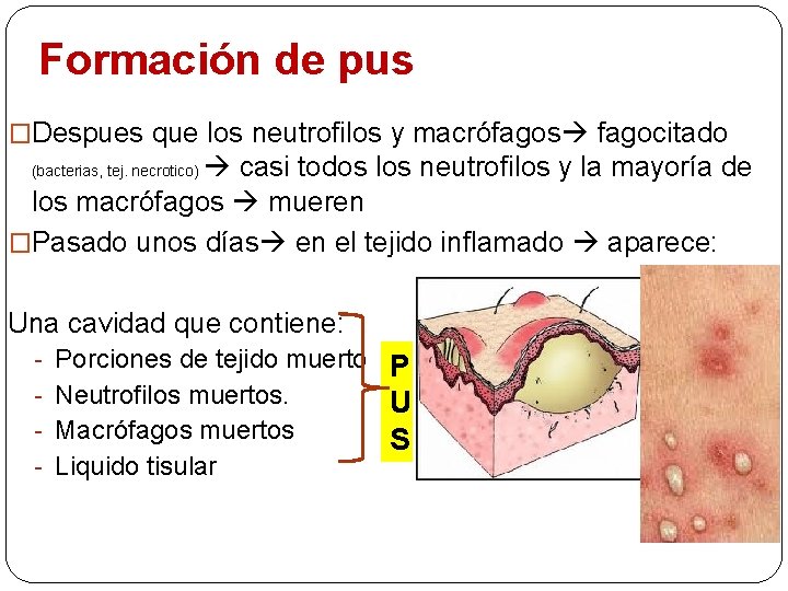 Formación de pus �Despues que los neutrofilos y macrófagos fagocitado casi todos los neutrofilos