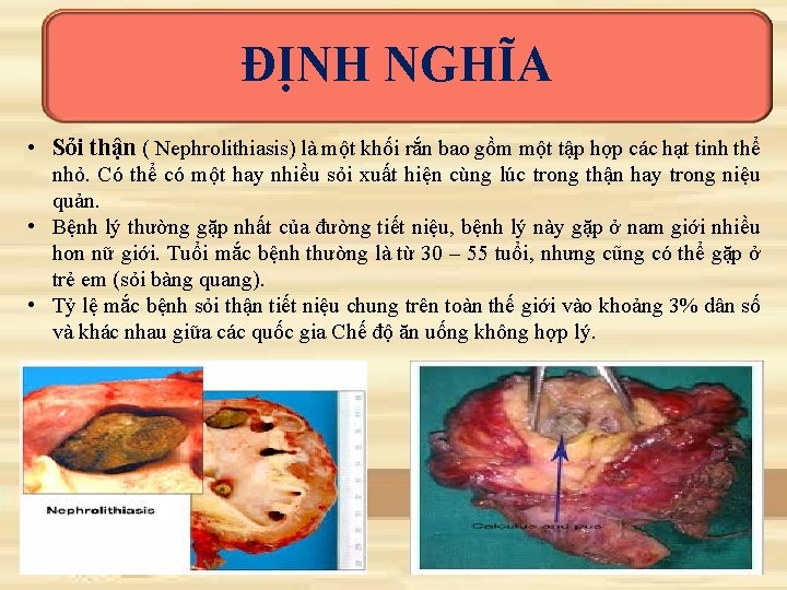 ĐỊNH NGHĨA • Sỏi thận ( Nephrolithiasis) là một khối rắn bao gồm một ĐỊNH NGHĨA • Sỏi thận ( Nephrolithiasis) là một khối rắn bao gồm một