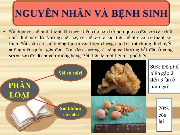 NGUYÊN NH N VÀ BỆNH SINH • Sỏi thận có thể hình thành khi