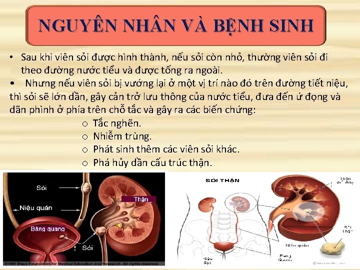 NGUYÊN NH N VÀ BỆNH SINH • Sau khi viên sỏi được hình thành,