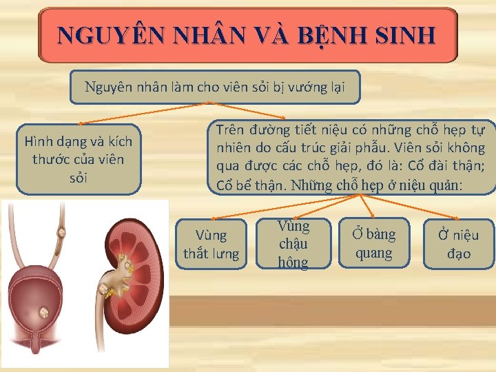NGUYÊN NH N VÀ BỆNH SINH Nguyên nhân làm cho viên sỏi bị vướng NGUYÊN NH N VÀ BỆNH SINH Nguyên nhân làm cho viên sỏi bị vướng