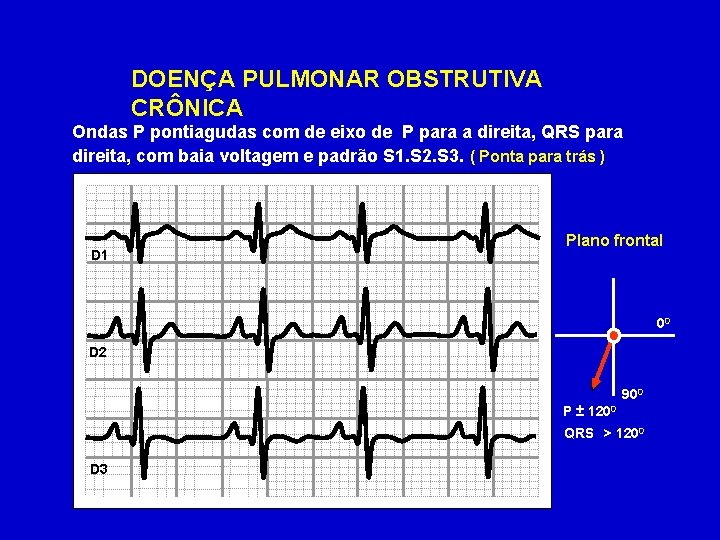 DOENÇA PULMONAR OBSTRUTIVA CRÔNICA Ondas P pontiagudas com de eixo de P para a