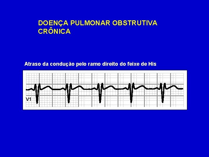 DOENÇA PULMONAR OBSTRUTIVA CRÔNICA Atraso da condução pelo ramo direito do feixe de His