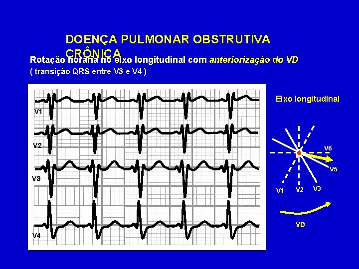 DOENÇA PULMONAR OBSTRUTIVA CRÔNICA Rotação horária no eixo longitudinal com anteriorização do VD (