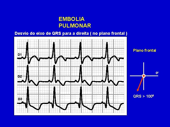 EMBOLIA PULMONAR Desvio do eixo de QRS para a direita ( no plano frontal