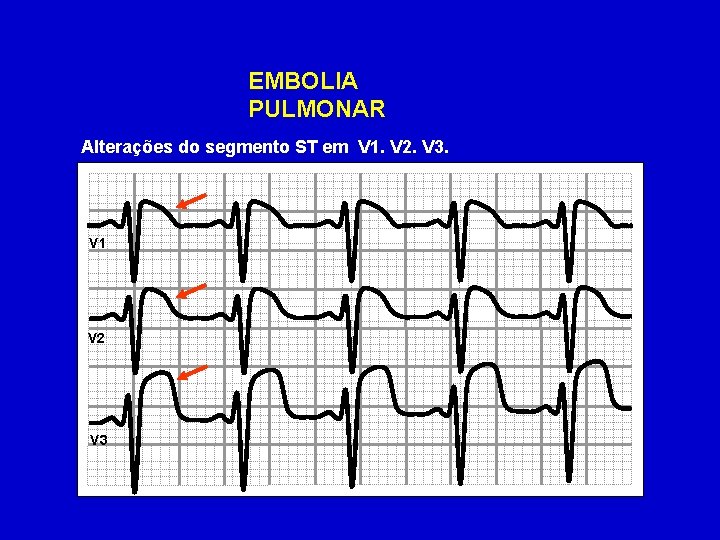 EMBOLIA PULMONAR Alterações do segmento ST em V 1. V 2. V 3. V