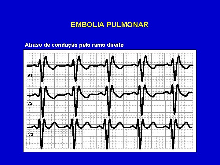 EMBOLIA PULMONAR Atraso de condução pelo ramo direito V 1 V 2 V 3