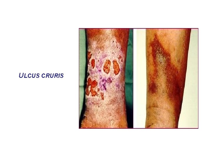 ULCUS CRURIS ULCUS CRURIS