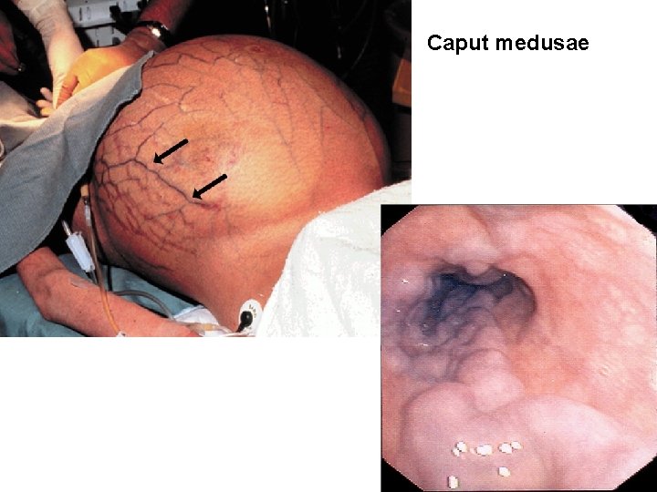 Caput medusae 