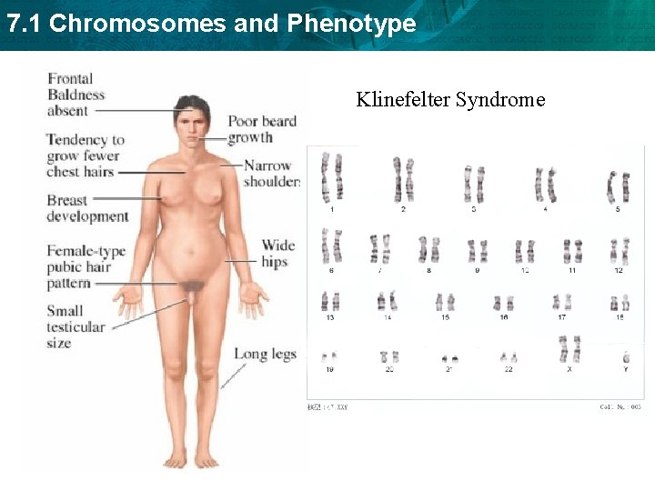 7. 1 Chromosomes and Phenotype Klinefelter Syndrome 