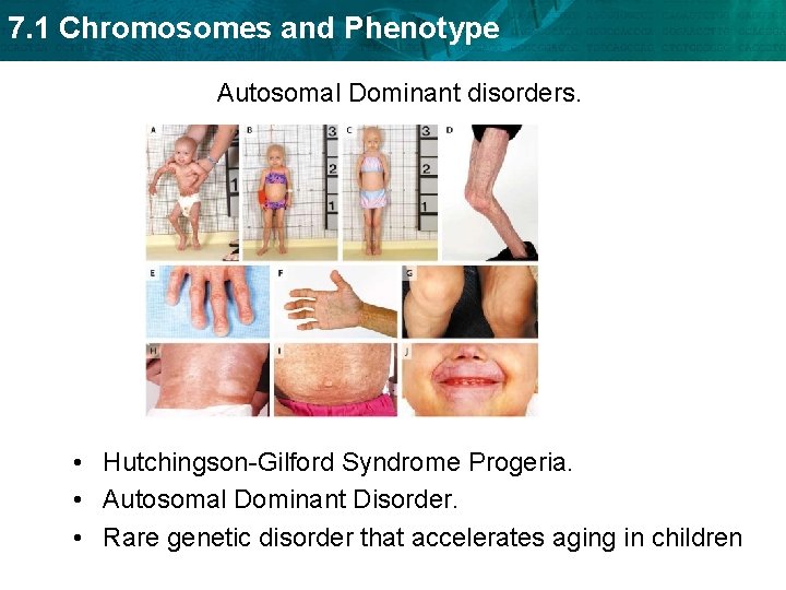 7. 1 Chromosomes and Phenotype Autosomal Dominant disorders. • Hutchingson-Gilford Syndrome Progeria. • Autosomal