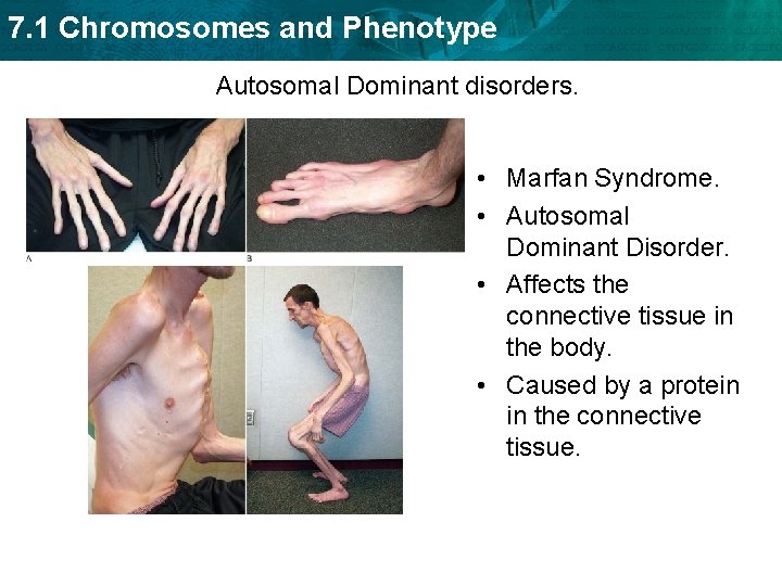 7. 1 Chromosomes and Phenotype Autosomal Dominant disorders. • Marfan Syndrome. • Autosomal Dominant