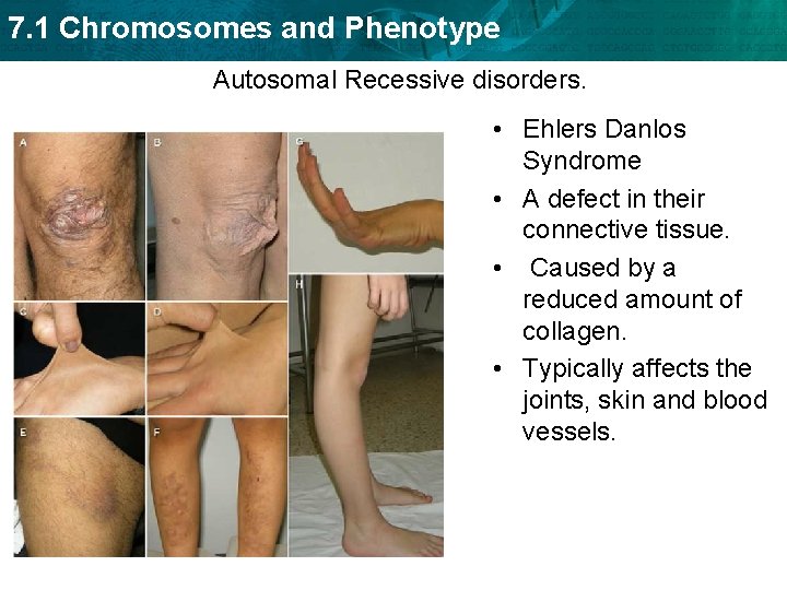 7. 1 Chromosomes and Phenotype Autosomal Recessive disorders. • Ehlers Danlos Syndrome • A