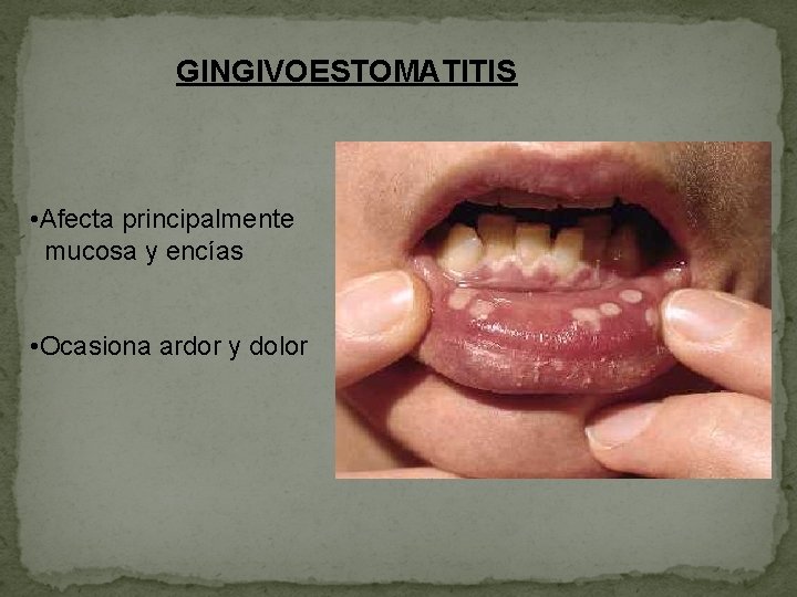 GINGIVOESTOMATITIS • Afecta principalmente mucosa y encías • Ocasiona ardor y dolor 