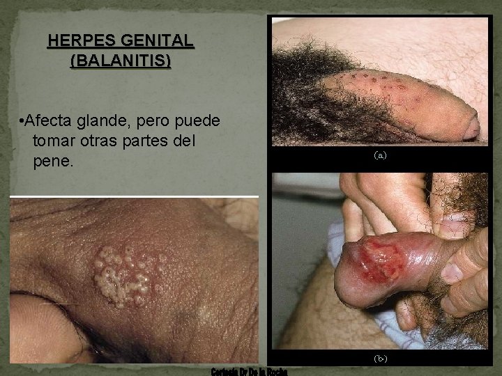 HERPES GENITAL (BALANITIS) • Afecta glande, pero puede tomar otras partes del pene. 