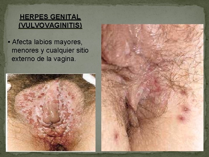 HERPES GENITAL (VULVOVAGINITIS) • Afecta labios mayores, menores y cualquier sitio externo de la