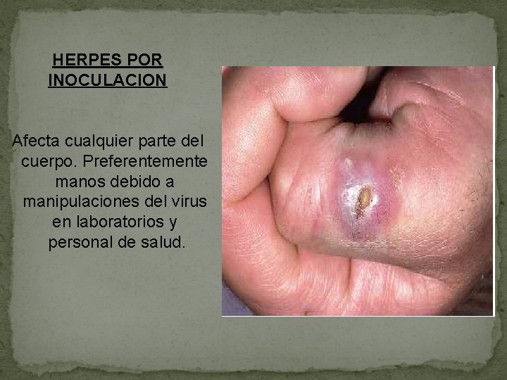 HERPES POR INOCULACION Afecta cualquier parte del cuerpo. Preferentemente manos debido a manipulaciones del