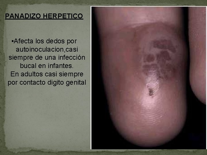 PANADIZO HERPETICO • Afecta los dedos por autoinoculacion, casi siempre de una infección bucal