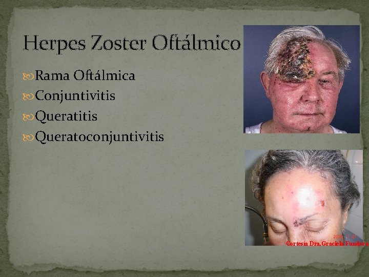 Herpes Zoster Oftálmico Rama Oftálmica Conjuntivitis Queratoconjuntivitis Cortesía Dra. Graciela Fundora 