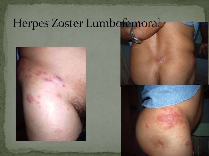 Herpes Zoster Lumbofemoral 