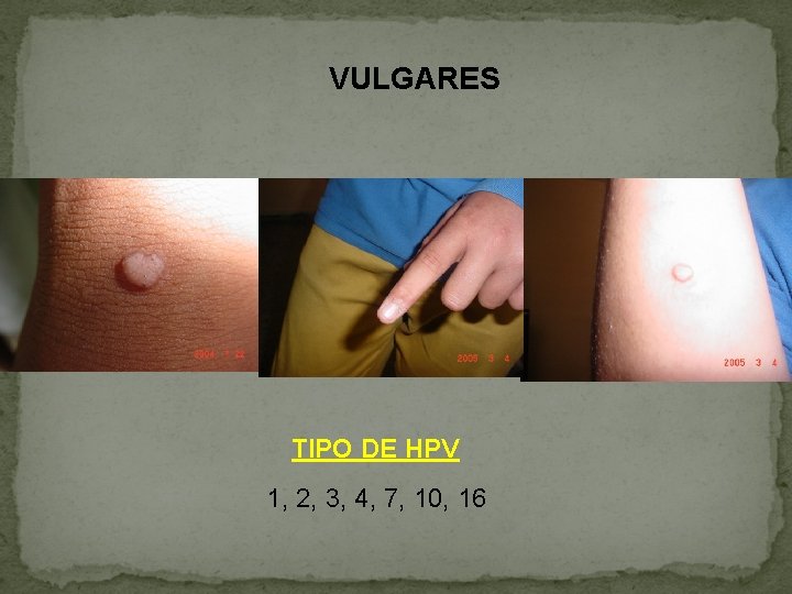 VULGARES TIPO DE HPV 1, 2, 3, 4, 7, 10, 16 