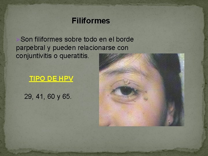Filiformes ØSon filiformes sobre todo en el borde parpebral y pueden relacionarse conjuntivitis o