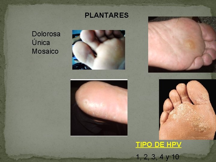 PLANTARES Dolorosa Única Mosaico TIPO DE HPV 1, 2, 3, 4 y 10 