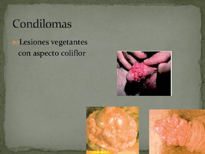 Condilomas Lesiones vegetantes con aspecto coliflor 