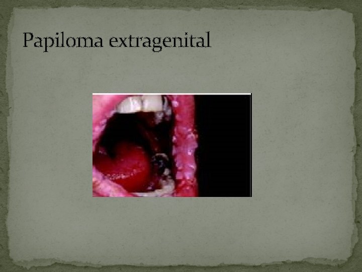 Papiloma extragenital 