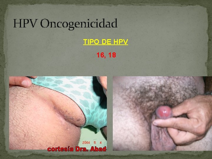 HPV Oncogenicidad TIPO DE HPV 16, 18 