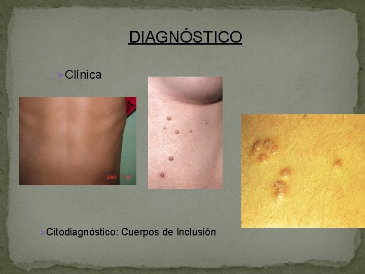 DIAGNÓSTICO ØClínica ØCitodiagnóstico: Cuerpos de Inclusión 