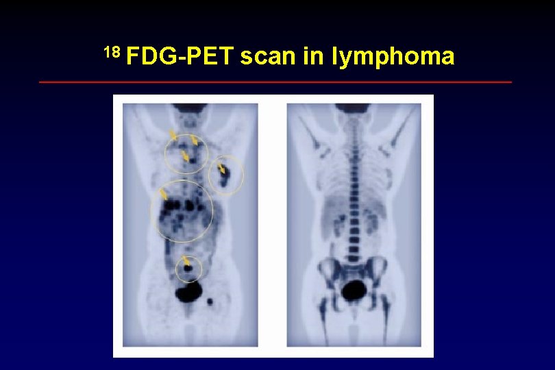 18 FDG-PET scan in lymphoma 