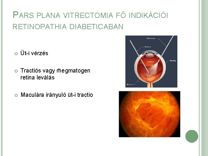 A diabéteszes retinopátia tünetei és kezelése