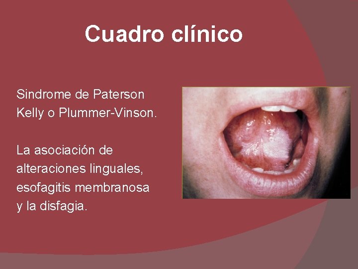 Cuadro clínico Sindrome de Paterson Kelly o Plummer-Vinson. La asociación de alteraciones linguales, esofagitis