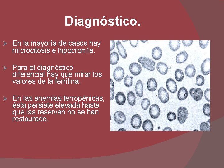 Diagnóstico. Ø En la mayoría de casos hay microcitosis e hipocromía. Ø Para el