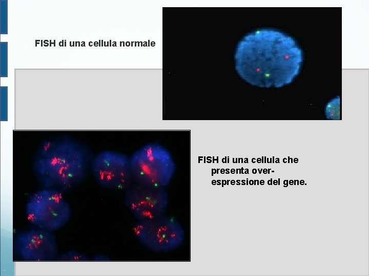 FISH di una cellula normale FISH di una cellula che presenta overespressione del gene.